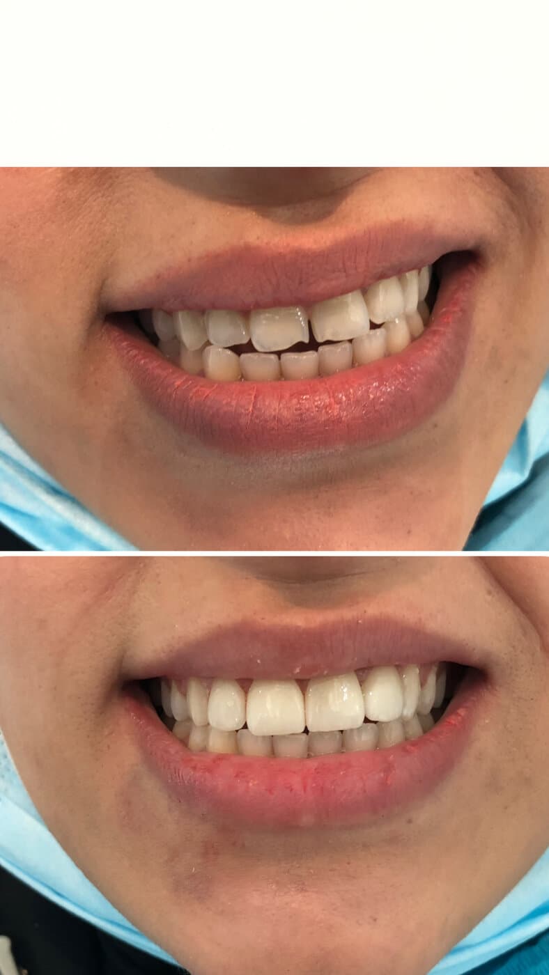 Front-tooth veneers — chipped edges restored