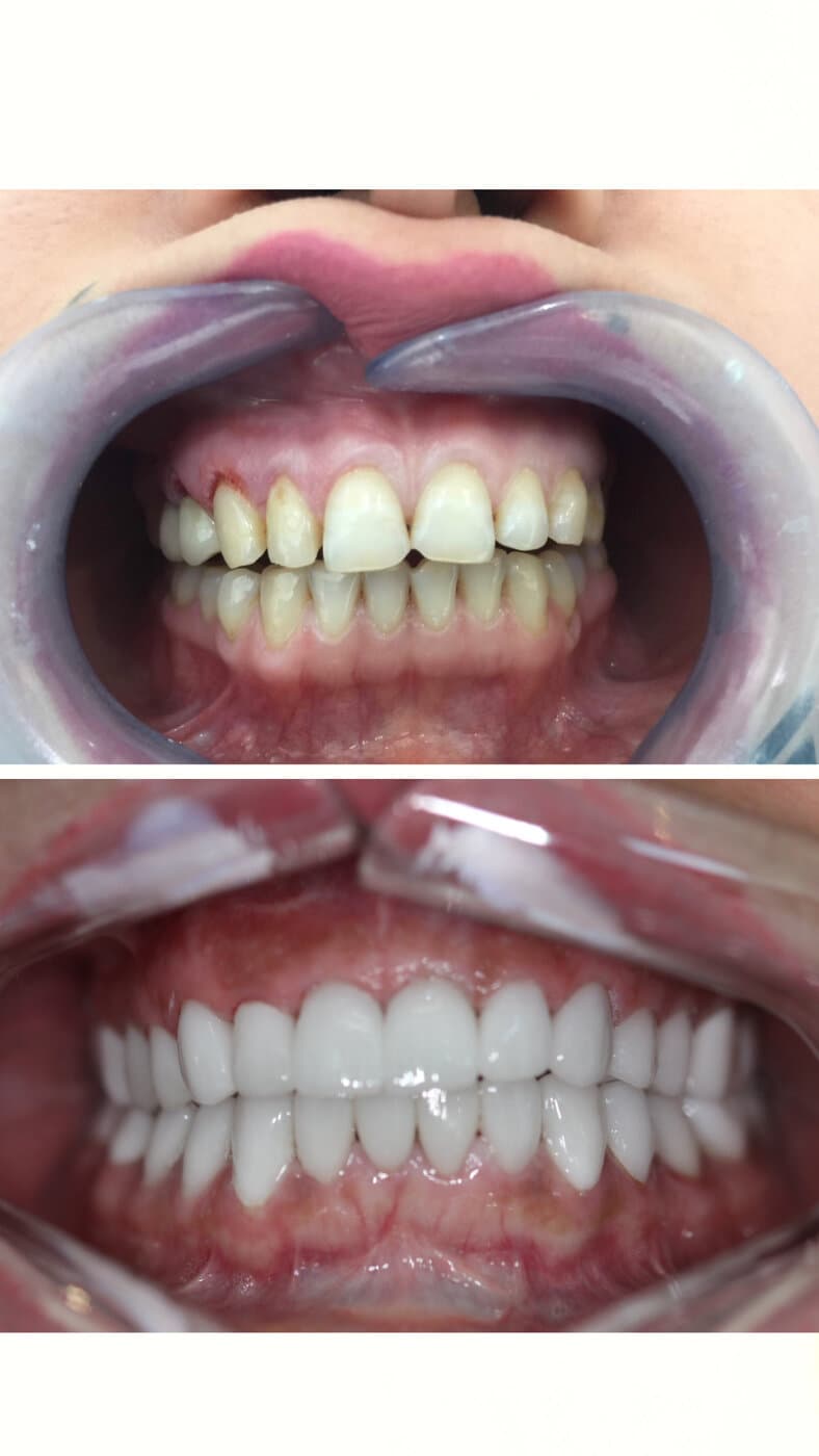 Full-mouth veneers — colour, shape, and alignment rebuilt