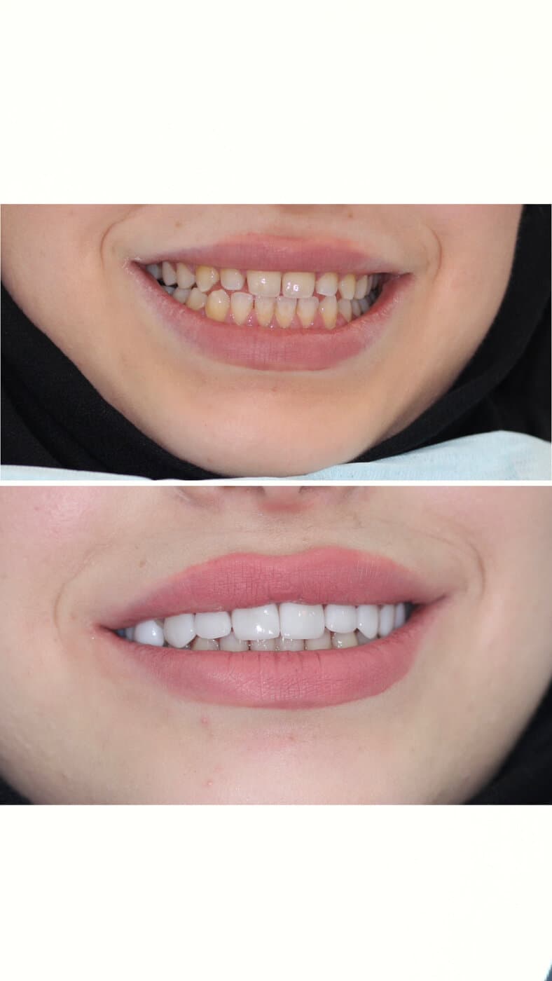 Aesthetic veneers — brighter, balanced smile line
