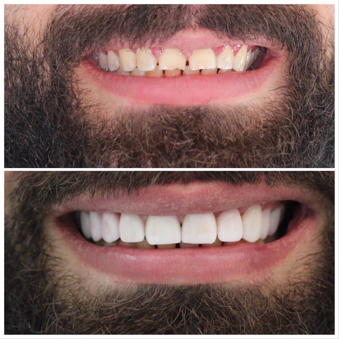 Porcelain veneers — full smile makeover