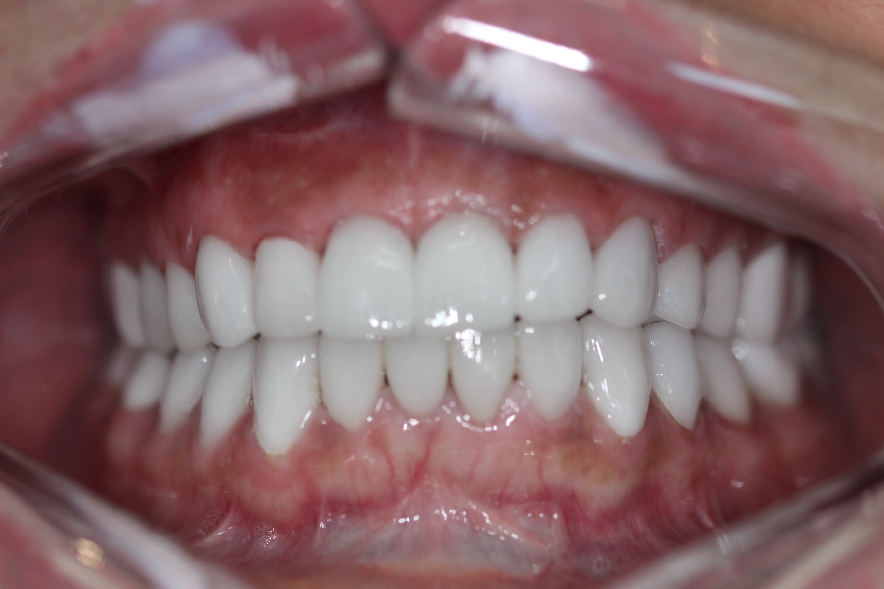 Full upper-arch crowns