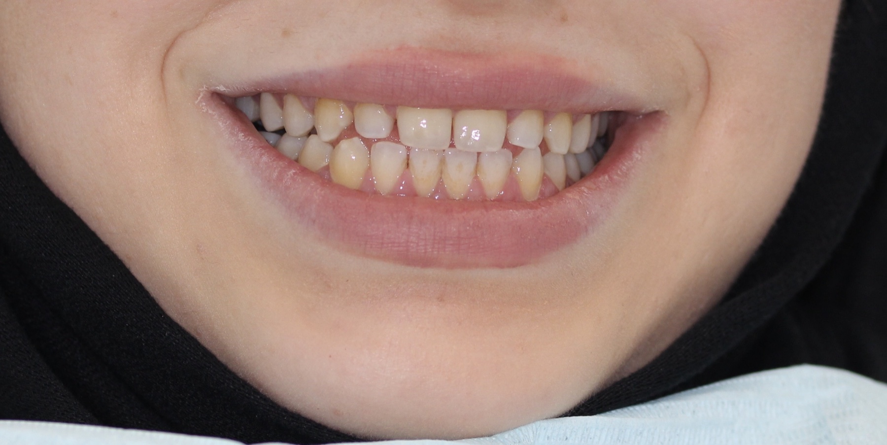 Full-mouth rehabilitation — gaps closed, alignment restored