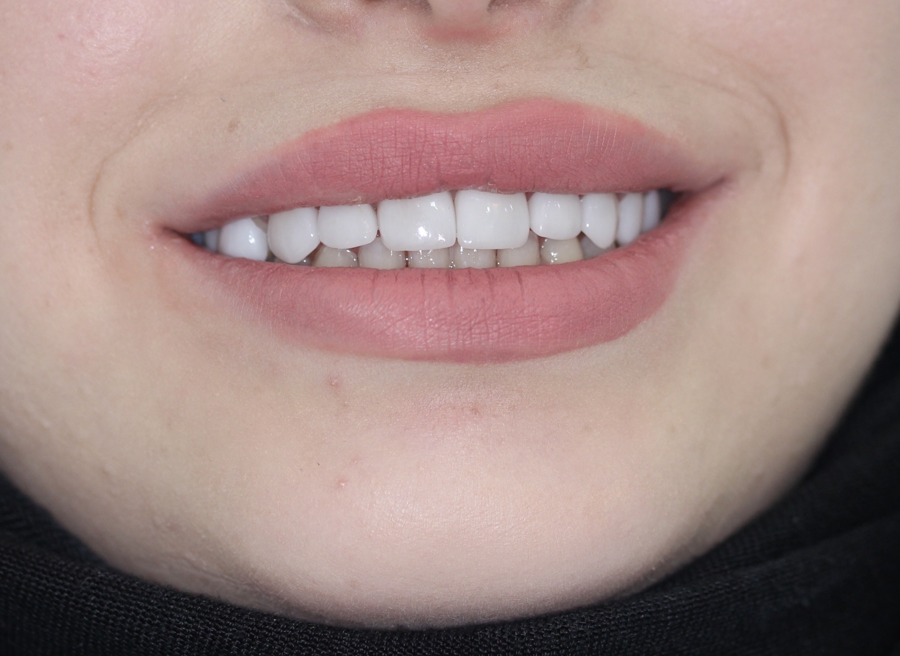 Porcelain veneers — full upper smile