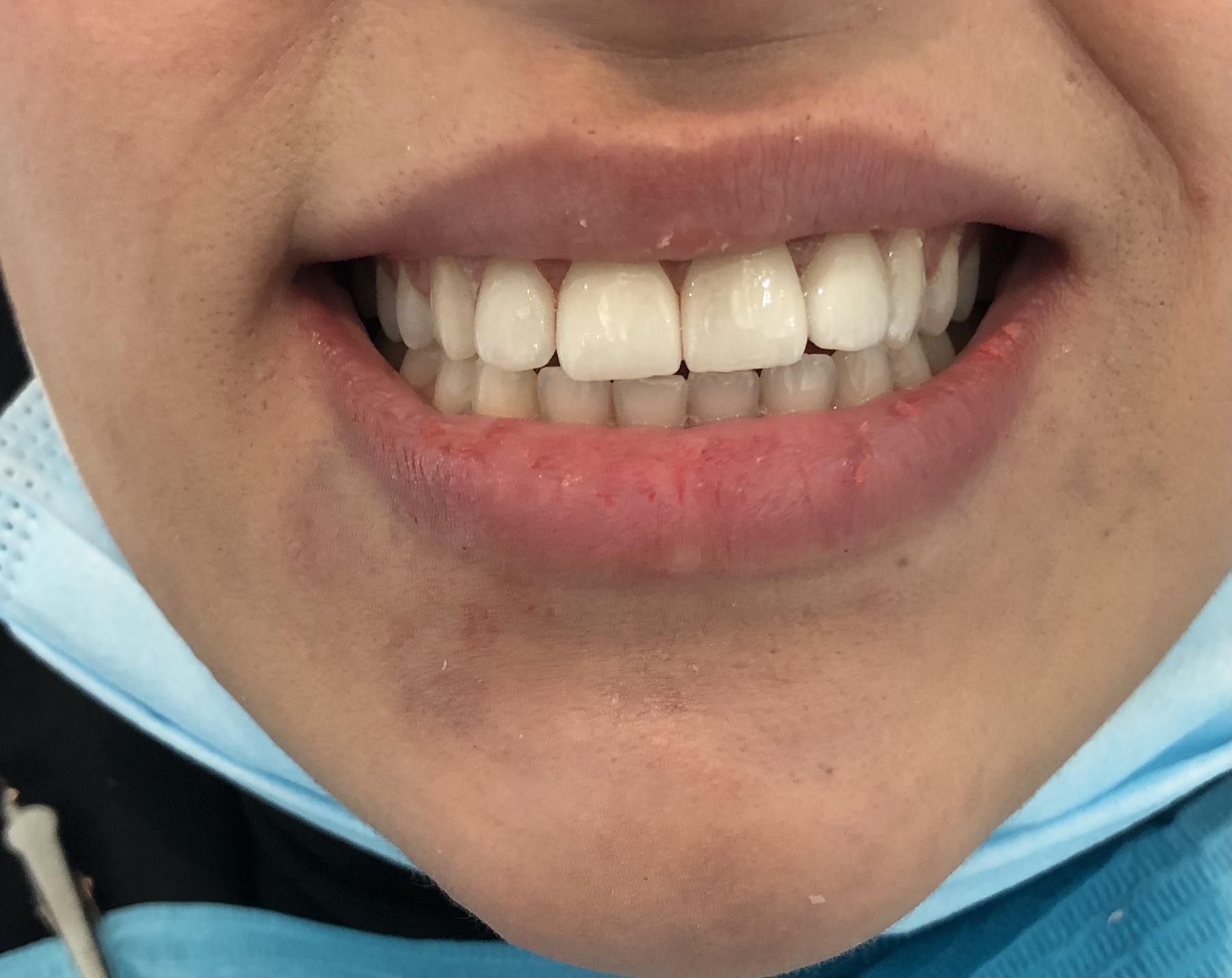Aesthetic veneers — corrected proportions